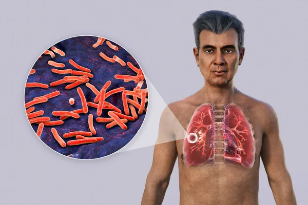 Photorealistic Illustration Upper Half Man Transparent Skin Showcasing Lungs Affected — Stock Photo, Image