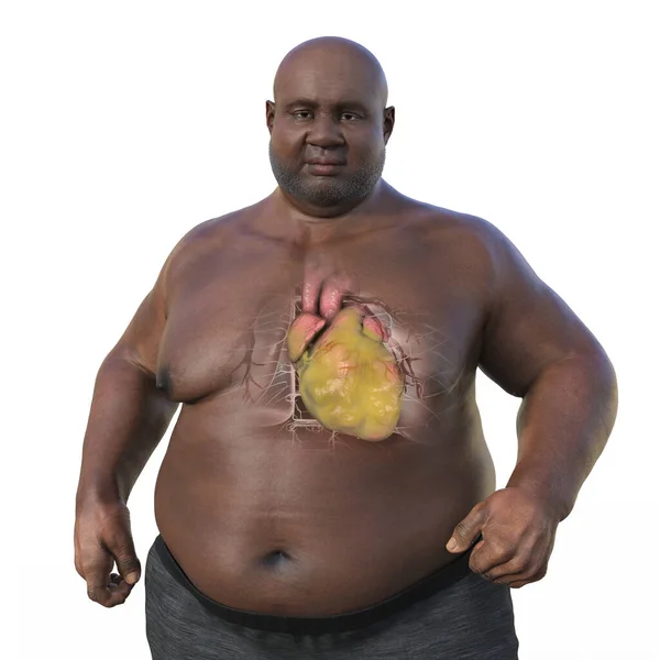 Illustrazione Medica Uomo Anziano Sovrappeso Con Pelle Trasparente Che Mostra — Foto Stock