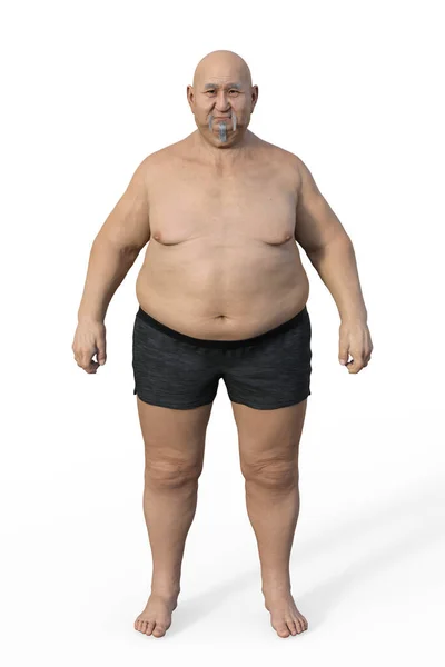 Vědecká Ilustrace Celého Těla Staršího Nadváhy Asijského Muže Zdůrazňující Důsledky — Stock fotografie