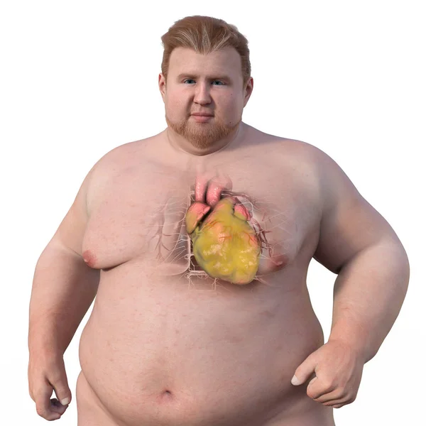 Medyczna Ilustracja Otyłego Mężczyzny Przezroczystą Skórą Powiększonym Otyłym Sercem — Zdjęcie stockowe
