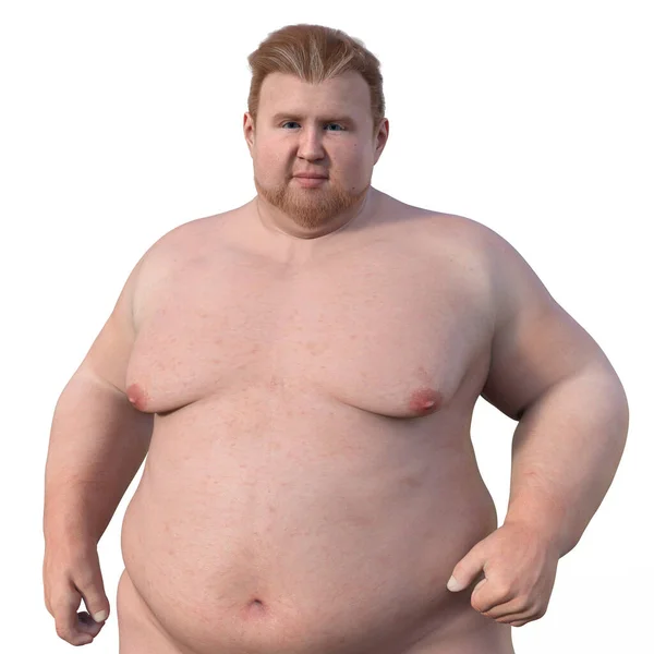 太りすぎの白い肌の男の3D科学的なイラスト 彼の体の上部を強調 健康への肥満の影響を強調 — ストック写真