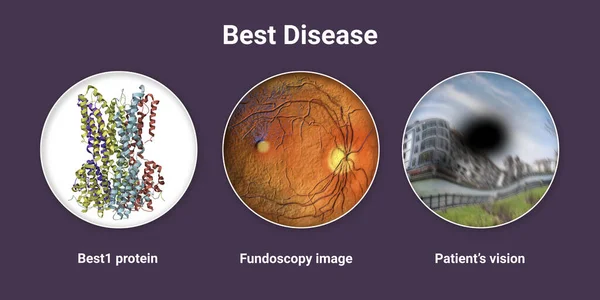 Beste Ziekte Beste Vitelliforme Macula Dystrofie Illustratie Met Best1 Eiwit — Stockfoto