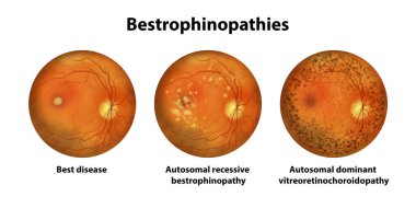 Bestrofenopatikler, kalıtsal retina bozuklukları, Best1 genindeki mutasyonlar, çizimler. En iyi hastalık, otozomal çekinik bestrofenopati, otozomal baskın vitreoretinokoroidopati.