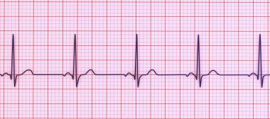 Normal bir elektrokardiyogram EKG, sağlıklı bir bireyde kalbin elektriksel aktivitesini gösteren 3 boyutlu bir çizim..