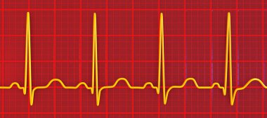 Elektrokardiyogramın detaylı bir 3D çizimi sinüs taşikardisi gösteriyor. Kalp ritmi normal kalp ritmi 90-100 bpm 'in üst sınırından daha yüksek..