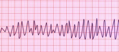 ECG göstergesi Torsades de point ritmi, tehlikeli kalp ritmi hızlı, düzensiz ritimler elektrik ekseni etrafında dönerek, potansiyel olarak bayılma veya kalp durmasına neden olur, 3D illüstrasyon
