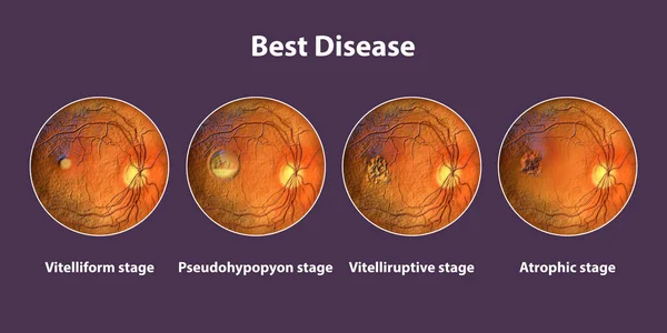 Stadien Der Besten Krankheit Ophthalmoskop Ansicht Wissenschaftliche Illustration — Stockfoto