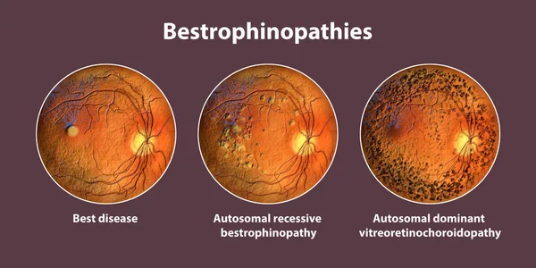Bestrophinopathies Inherited Retinal Disorders Caused Mutations Best1 Gene Render Best — Stock Photo, Image