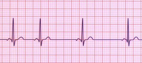 Uma Ilustração Detalhada Eletrocardiograma Ecg Que Mostra Arritmia Sinusal Uma — Fotografia de Stock