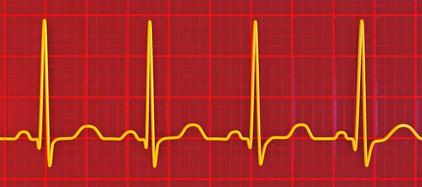 心电图心电图显示窦性心动过速的详细三维图像 窦性心动过速是一种有规律的心率 高于成年人90 100 Bpm正常心率的上限 — 图库照片