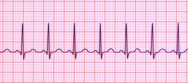 Illustration Détaillée Électrocardiogramme Ecg Montrant Une Tachycardie Sinusale Rythme Cardiaque — Photo