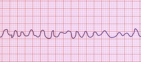 Illustration Scientifique Représentant Électrocardiogramme Ecg Montrant Rythme Chaotique Fibrillation Ventriculaire — Photo