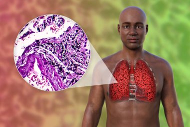 Şeffaf derili bir Afrikalı 'nın üst kısmının 3 boyutlu fotorealistik çizimi sigara içen bir adamın akciğerlerinin durumunu ve sigara içmekten etkilenen akciğerlerin mikro-grafik görüntüsünü ortaya koyuyor..
