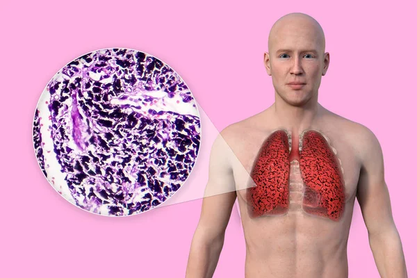 Illustration Övre Halvan Man Med Genomskinlig Hud Avslöjar Tillståndet Rökarens — Stockfoto