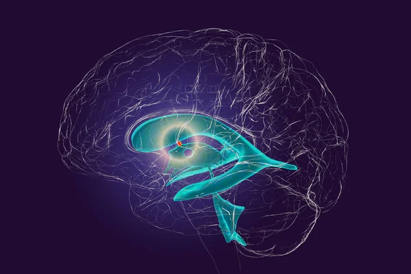 Müdahale Triküler Forameni Beyin Yanal Ventriküllerini Birbirine Bağlayan Serebrospinal Sıvının — Stok fotoğraf
