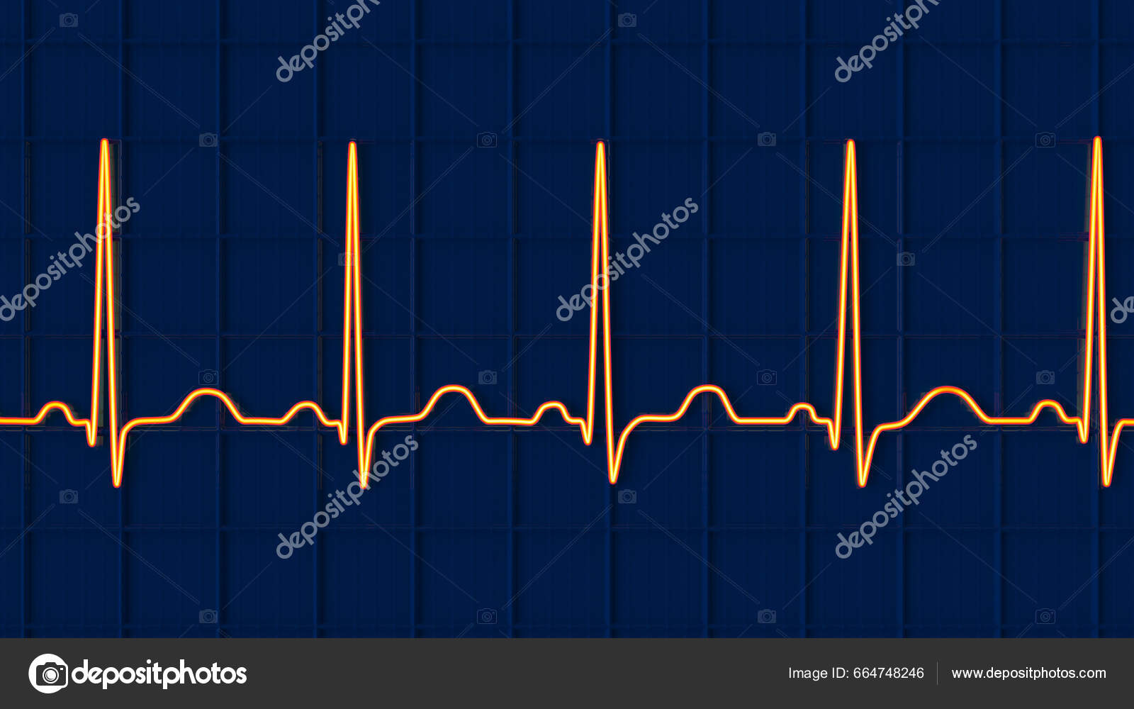 Junctional Bradycardia Rhythm Strip