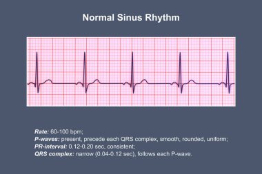 Normal bir elektrokardiyogram EKG, sağlıklı bir bireyde kalbin elektriksel aktivitesini gösteren 3 boyutlu bir çizim..
