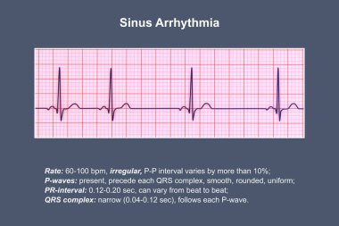 Sinüs aritmisini gösteren elektrokardiyogramın ayrıntılı bir 3D çizimi sinüs düğümünden kaynaklanan düzensiz kalp ritmiyle karakterize edilen bir durumdur..