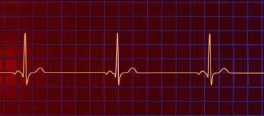 Sinüs bradikardisi gösteren bir elektrokardiyogramın detaylı bir 3D çizimi. Sinüs düğümünden kaynaklanan yavaş kalp atışlarıyla karakterize edilen bir durum. Genellikle dakikada 60 'ın altında..