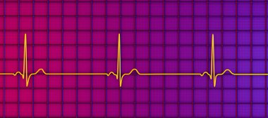 Sinüs bradikardisi gösteren bir elektrokardiyogramın detaylı bir 3D çizimi. Sinüs düğümünden kaynaklanan yavaş kalp atışlarıyla karakterize edilen bir durum. Genellikle dakikada 60 'ın altında..