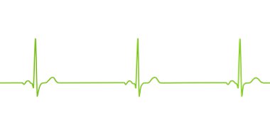 Sinüs bradikardisi gösteren bir elektrokardiyogramın detaylı bir 3D çizimi. Sinüs düğümünden kaynaklanan yavaş kalp atışlarıyla karakterize edilen bir durum. Genellikle dakikada 60 'ın altında..