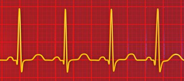 Elektrokardiyogramın detaylı bir 3D çizimi sinüs taşikardisi gösteriyor. Kalp ritmi normal kalp ritmi 90-100 bpm 'in üst sınırından daha yüksek..