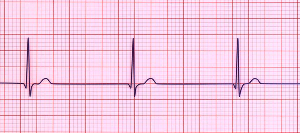 Elettrocardiogramma Ecg Che Mostra Ritmo Congiunzionale Che Verifica Quando Segnali — Foto Stock