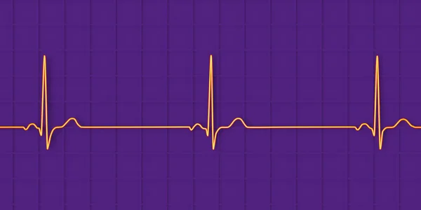 一个显示窦性心律失常的详细的三维心电图 其特点是窦性节律性心率缓慢 通常低于每分钟60下 — 图库照片