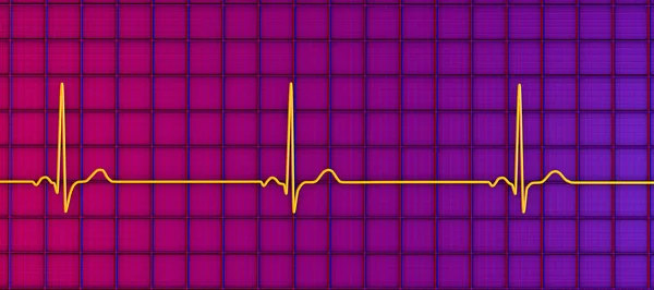Детальна Ілюстрація Електрокардіограми Відображає Синусову Брадікардію Стан Характеризується Повільним Серцевим — стокове фото