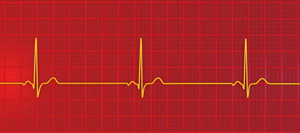 Подробная Иллюстрация Электрокардиограммы Показывающая Синусовую Брадикардию Состояние Характеризующееся Медленным Сердечным — стоковое фото