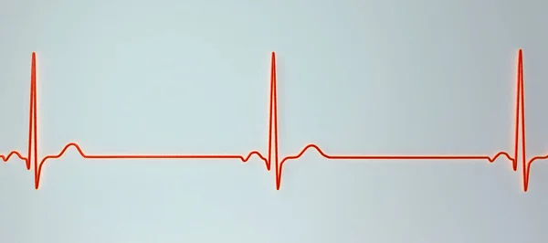 Részletes Illusztráció Egy Elektrokardiogram Megjelenítő Sinus Bradycardia Olyan Állapot Jellemzi — Stock Fotó