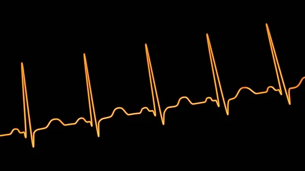 Λεπτομερής Τρισδιάστατη Απεικόνιση Ηλεκτροκαρδιογραφήματος Ηκγ Φλεβοκομβική Ταχυκαρδία Τακτικός Καρδιακός Ρυθμός — Φωτογραφία Αρχείου