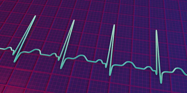 Una Ilustración Detallada Electrocardiograma Ecg Que Muestra Taquicardia Sinusal Ritmo —  Fotos de Stock