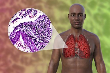 Şeffaf derili bir Afrikalı 'nın üst kısmının 3 boyutlu fotorealistik çizimi sigara içen bir adamın akciğerlerinin durumunu ve sigara içmekten etkilenen akciğerlerin mikro-grafik görüntüsünü ortaya koyuyor..