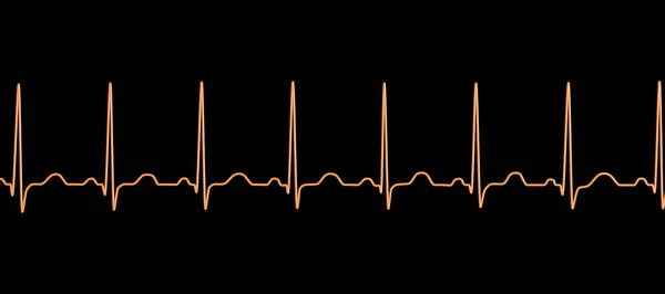 Una Ilustración Detallada Electrocardiograma Ecg Que Muestra Taquicardia Sinusal Ritmo — Foto de Stock
