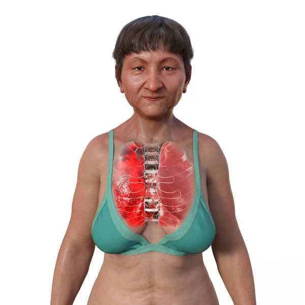 透明な肌の女性の上半分の3Dフォトリアリスティックなイラスト 肺炎の影響を受けた肺を紹介します — ストック写真