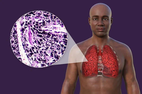 A 3D photorealistic illustration of the upper half part of an African man with transparent skin, revealing the condition of smoker's lungs, along with a micrograph image of lungs affected by smoking.