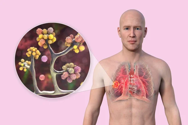 图为一个皮肤透明男子上半身的3D照片 显示了肺部黏液真菌病的病灶 并近距离观察了金银花真菌 — 图库照片