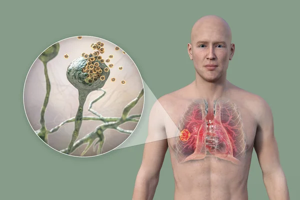 一个有透明皮肤的男子上半身的3D照片 揭示了肺黏液菌病的病变 并近距离观察了根霉病菌 — 图库照片