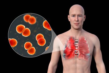 Üç boyutlu fotorealistik bir illüstrasyon şeffaf derili bir adamın üst yarısını gösteriyor, akciğerleri zatürreeden etkilenmiş, ve Streptococcus pneumoniae bakterisinin yakından görüntüsünü ortaya çıkarıyor..