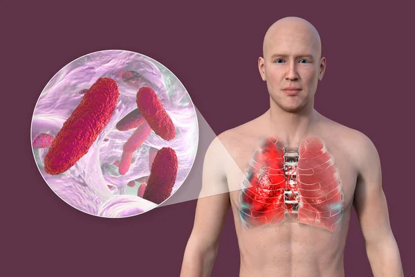 一个3D的照片逼真地展示了一个皮肤透明的男人的上半身 揭示了肺部感染肺炎的情况 以及肺炎克雷伯菌的特写 — 图库照片