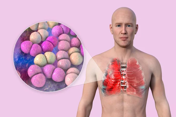 一个3D的照片逼真地展示了一个皮肤透明的男子上半身 揭示了肺部感染肺炎的情况 以及肺炎链球菌的近景 — 图库照片