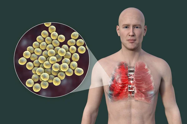 一个3D的照片逼真地展示了一个皮肤透明的男人上半身 揭示了肺部感染肺炎的情况 以及金黄色葡萄球菌的特写 — 图库照片