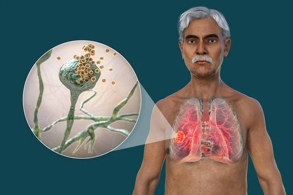 老年男性透明皮肤患者上半部分3D照片 显示肺黏液真菌病病灶 近视根霉菌 — 图库照片