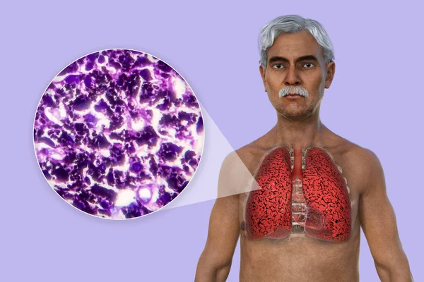 Illustration Upper Half Part Man Transparent Skin Revealing Condition Smoker — Stock Photo, Image