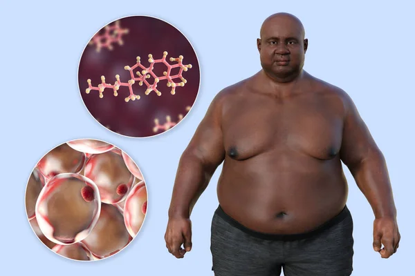 Illustrazione Medica Con Uomo Sovrappeso Con Una Visione Ravvicinata Degli — Foto Stock