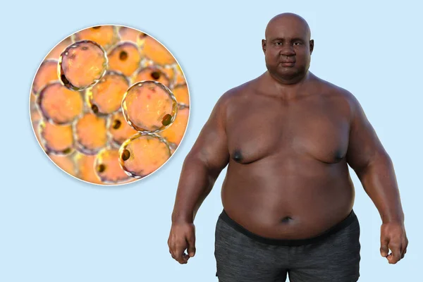 Medical Illustration Depicting Overweight Man Close View Adipocytes Highlighting Role — Stock Photo, Image