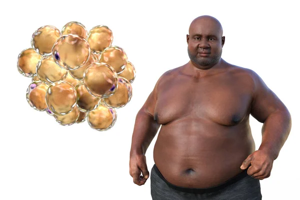 Medical Illustration Depicting Overweight Man Close View Adipocytes Highlighting Role — Stock Photo, Image