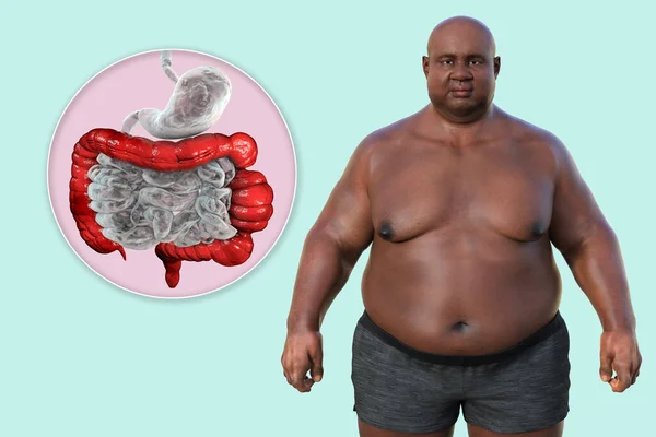 Hombre Con Sobrepeso Vista Cerca Sistema Digestivo Destacando Presencia Espasmos — Foto de Stock