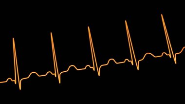 Elektrokardiyogramın detaylı bir 3D çizimi sinüs taşikardisi gösteriyor. Kalp ritmi normal kalp ritmi 90-100 bpm 'in üst sınırından daha yüksek..